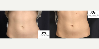 Woman treated with SculpSure - Woman treated with SculpSure