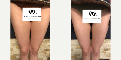 Woman treated with SculpSure - Woman treated with SculpSure
