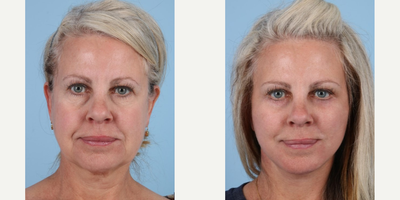 Woman treated with Facelift - Facelift and Deep Plane Facelift