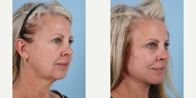 Woman treated with Facelift - Facelift and Deep Plane Facelift