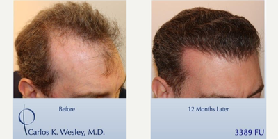 35-44 year old man treated with Hair Transplant - This 44-year-old man underwent a follicular unit transplantation (FUT) session with Dr. Carlos K. Wesley in which a total of 3389 grafts were placed. We are thrilled that our surgical facility is considered amongst the worlds best. Aspects of our surgical approach can be viewed on our sites Most Common Questions page. Three unique elements combined to help improve his experience: no-shave requirement for optimal discretion, enhanced graft storage measures, and rigid patient safety standards.  As with all of Dr. Wesleys patients, he was NOT required to cut his hair for the procedure.  As a result, this patient was able to return comfortably to work and social activities within approximately 7-10 days of his procedure. The patients hair follicles were incubated in platelet rich plasma (PRP) throughout the duration of the procedure.  This, combined with an ATP-containing storage solution has been shown to enhance survival of transplanted hairs.