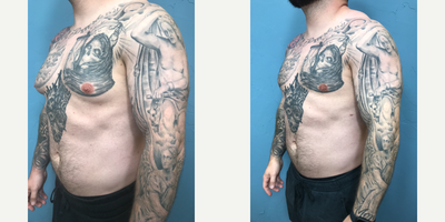 25-34 year old man treated with Gynecomastia Surgery - Male breast reduction