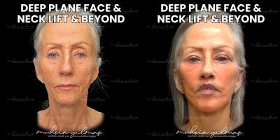 55-64 year old woman treated with Deep Plane Facelift, Deep Neck Lift, Eyelid Surgery, Lip Lift, Facial Fat Transfer - This 63-year-old patient underwent a comprehensive facial rejuvenation including Deep Plane Facelift, Deep Neck Lift, Temporal Lift, Upper Eyelid Surgery, Cantopexy, Lip Lift, Corner Lift, Fat Grafting, and CO2 Laser.At just a few weeks post-op, she already shows a refreshed, lifted, and smoother appearance. The eyes are brighter, the mid and lower face more defined, and skin texture visibly improvedachieving a naturally youthful and elegant look.