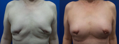 65-74 year old woman treated with Breast Fat Transfer - 67-year-old lady underwent bilateral breast augmentation. The patient had her breast implants removed, and Dr. Tehrani performed one session of an autologous fat transfer to the breasts.