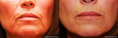 Juvederm - Juvederm