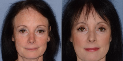 J-Plasma Helium Based Facial Resurfacing - J-Plasma facial rejuvenation resurfacing of spots, wrinkles and different pigments
