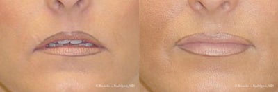 Lip Augmentation - 	Performed a lip augmentation on this patient with Advanta implants in both the upper and the lower lips. The lip augmentation had the effect of lifting up the corners of the mouth so that the patient had a more pleasant facial expression following the surgery.