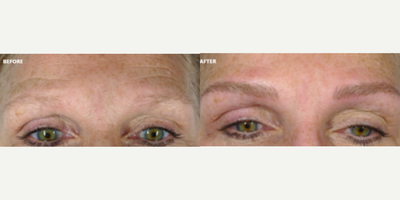 Woman treated with Eyelid Surgery - Woman treated with Eyelid Surgery