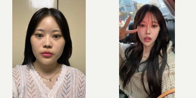 25-34 year old woman treated with Cheekbone Reduction, Jaw Reduction - 3-Month Real Review  Facial Contouring at XO Plastic Surgery