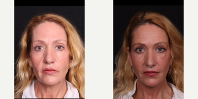 55-64 year old woman treated with Facelift, Eyelid Surgery, Double Eyelid Surgery, Brow Lift, Neck Lift, Facial Fat Transfer - Deep plane facelift, necklift, fat transfer, quad blepharoplasty B&A.