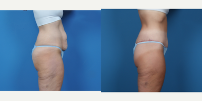 45-54 year old woman treated with Breast Augmentation, Liposuction, Mommy Makeover, Tummy Tuck - CIRCUMFERENTIAL ABDOMINOPLASTY. BILATERAL BREAST AUGMENTATION WITH VERTICAL MASTOPEXY