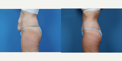 45-54 year old woman treated with Breast Augmentation, Liposuction, Mommy Makeover, Tummy Tuck - CIRCUMFERENTIAL ABDOMINOPLASTY. BILATERAL BREAST AUGMENTATION WITH VERTICAL MASTOPEXY