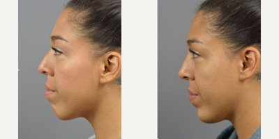 Moman treated with Chin Filler - Facial Asymmetry and contour is natural and makes each face unique. While most imperfections go unnoticed by the outside world. Often times we treat with surgical interventions but for a temporary adustment with just as much impact the use of Botox and Filler can be used. Non-surgical Rhinoplasty by Dr. James Marotta complimented by filler injections to the chin.