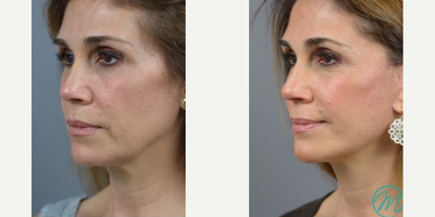 Woman treated with Mini Facelift - The procedure is designed to decrease deep creases along the chin and mouth, address loose skin along the neck, and reduce the formation of jowls beneath the chin. For our patient, many of her concerns did not require a full Facelift procedure, and could instead be targeted with a Mini Facelift.
