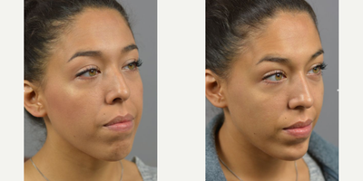 Moman treated with Chin Filler - Facial Asymmetry and contour is natural and makes each face unique. While most imperfections go unnoticed by the outside world. Often times we treat with surgical interventions but for a temporary adustment with just as much impact the use of Botox and Filler can be used. Non-surgical Rhinoplasty by Dr. James Marotta complimented by filler injections to the chin.