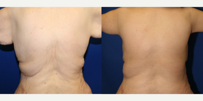45-54 year old woman treated with Back Lift - This patient was unhappy with her back rolls after losing weight. She desired a flat back. Dr. Katzen was able to remove excess skin and fat off her back by performing an upper body lift (also known as a vertical torsoplasty). She is happy with the results.