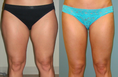 SMART Lipsuction to Outer and Inner Thighs - 	SMART Lipsuction to Outer and Inner Thighs