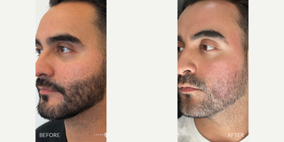 25-34 year old man treated with Fraxel Laser, CO2 Laser, Punch Excision - CO2 & Fraxel lasers remove skin layers to promote new growth, while punch excision physically removes scar tissue. The best option depends on scar type.