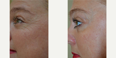 45-54 year old woman treated with Exilis - Photo courtesy of BTL - after 2 sessions