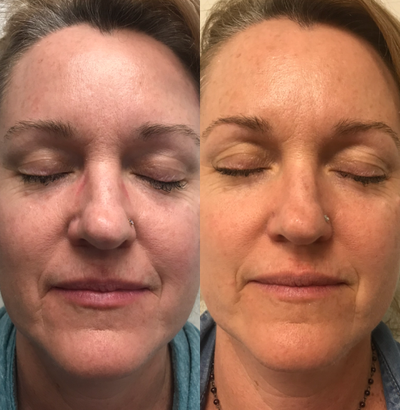 45-54 year old woman treated with VI Peel - ViPeel precision plus performed for anti-aging and pigmentation