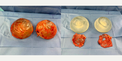 45-54 year old woman treated with Breast Implant Removal, Capsular Contracture Treatment - Female patient with breast implant illnes (BII) and Asia syndrome, she had an Enbloc capsulectomy.
