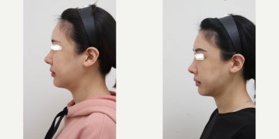 25-34 year old woman treated with AccuLift, Liposuction, Laser Liposuction - 26 Years old female patient Chief Complain: Puffiness and the lack of jaw contours, round shaped face (looking for V-line) Treatment Plan: ace liposuction (double chin, cheek bone, cheeks, near mouth)Outcome: pure fat liposuctioned : double chin (-20cc), middle face line (- 40cc) fresher look, V-lined face shape, more refined appearance