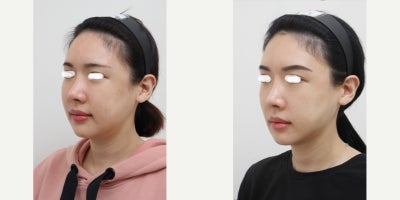 25-34 year old woman treated with AccuLift, Liposuction, Laser Liposuction - 26 Years old female patient Chief Complain: Puffiness and the lack of jaw contours, round shaped face (looking for V-line) Treatment Plan: ace liposuction (double chin, cheek bone, cheeks, near mouth)Outcome: pure fat liposuctioned : double chin (-20cc), middle face line (- 40cc) fresher look, V-lined face shape, more refined appearance