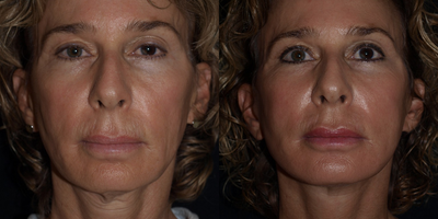 57 year old woman treated with Fat Transfer to face, facelift and TCA peel - 3 months after secondary facelift, fat transfers to face and 35% TCA peel