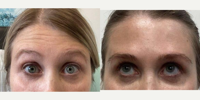 35-44 year old woman treated with Daxxify - 41 year old woman treated with Daxxify for frown lines
