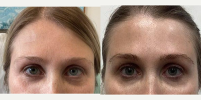 35-44 year old woman treated with Daxxify - 41 year old woman treated with Daxxify for frown lines