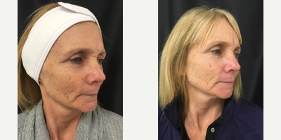 55-64 year old woman treated with Rejuvapen - This client uses products which helps with skin rejuvenation. Client is currently using vitamin A and Epionce Skincare Line.