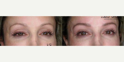 Woman treated with Microblading - Woman treated with Microblading