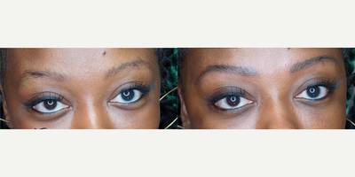 Woman treated with Microblading - Woman treated with Microblading