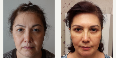 55-64 year old woman treated with Facelift - Macs Face Lift Surgery performed by Ozge Ergun, MD (6 months post op.)