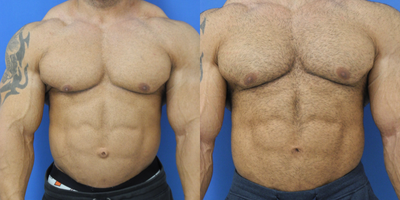 35-44 year old woman treated with Umbilical Hernia Repair - Pictured below is a 35 year old patient who is a World Champion Body Builder from Miami, Florida. Photograph taken 2 months after Gynecomastia and Umbilical Hernia repair. Just in time for the Mr. Olympia Competition in Las Vegas....and looking amazing!