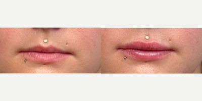 25-34 year old woman treated with Juvederm - Lip augmentation using one syringe of Juvederm Ultra