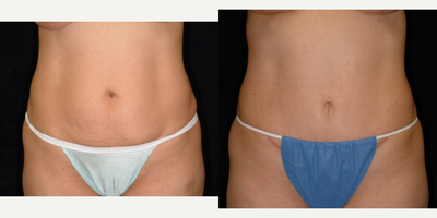 25-34 year old woman treated with Mini Tummy Tuck - Minit TT