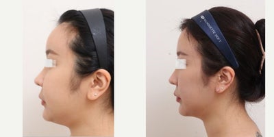 25-34 year old woman treated with AccuLift, Laser Liposuction - 28 Years old female patient Chief Complain: - over injected forehead (fat graft 3 years ago in X clinic) - double chin & overall facial fat Treatment Plan: full face liposuction /forehead reconstruction by liposuctionOutcome: - forehead liposuction pure fat: 20cc- double chin liposuction pure fat: 50- face liposuction pure fat : 124cc (cheek side, front, near ears, zygomatical angle)