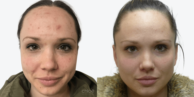 Face Age Spots Treatment using Chemical Peel - Solar lentigos, commonly called dark spots or age spots, are flat brown spots caused by sun exposure. They may be present all over the body surface, especially in the areas most exposed to UV rays. This condition can be effectively treated with chemical peels.