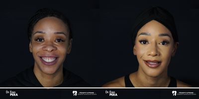 25-34 year old woman treated with Jaw Surgery - Orthognathic surgery ( lefort 1 osteotomy, Sagittal split ramus osteotomy, )