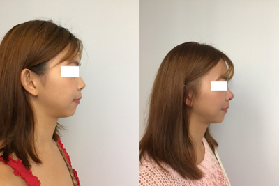 25-34 year old man treated with Accent Laser - 25-34 year old man treated with Accent Laser