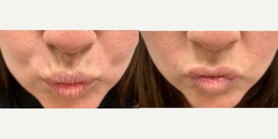 45-54 year old woman treated with Botox, Botox for Gummy Smile - Treated by Aubrey Houchin, RN