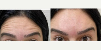 25-34 year old woman treated with Botox, Botox for Migraines - Treated by Aubrey Houchin