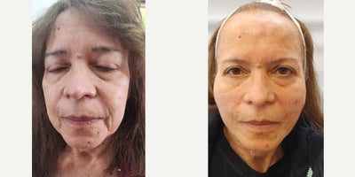 55-64 year old woman treated with Skin Rejuvenation - Before and after of a thread lift with PDO threads, the after photo is one hour later
