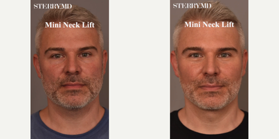Man treated with Buccal Fat Removal - Man treated with Mini Neck Lift, Chin/Neck Liposuction, Buccal Fat Removal, and Cheek Liposuction.