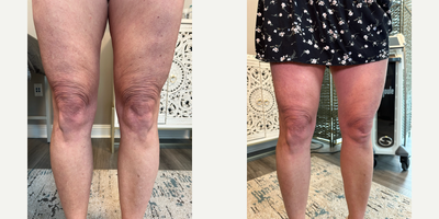 45-54 year old woman treated with Skintyte - Sciton's SkinTyte improves the Appearance of Skin Laxity. As we age, so does our skin. But that doesnt mean its game over. Toss out the ineffective creams and useless claims and improve the appearance of skin laxity with SkinTytethe powerful nonsurgical treatment for the face, neck, and body. The treatment utilizes advanced infrared light technology to improve the appearance of lax skin. In comparison to other methods, SkinTyte is considered a more effective light-based treatment for achieving the appearance of younger-looking skin. SkinTyte can help delay or eliminate the need for surgical procedures by improving the appearance of severe wrinkles and restoring a youthful contour to the face and body.