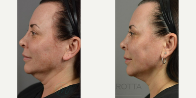Woman treated with Skin Tightening - At 3 months post-procedure. We see her everyday and think she looks amazing but when you see the face to face pics what a minimally invasive procedure can do! Tracy will continue to see skin tightening improvements over the next 3 months.Renuvion is a revolutionary new technology that lifts, tightens and smooths the skin from within, instantly erasing physical signs of aging and restoring the skins complexion progressively over time. Its cutting-edge technology combines helium gas with radiofrequency (RF) energy to tighten loose skin, iron out wrinkles and correct any unevenness in your skin tone. Renuvion can be used to treat the following concerns associated with aging:  Mild to moderate wrinkles and fine lines Loose or sagging skin on the face, neck, stomach, arms and legs Sun damage Acne scars Age spots Discoloration