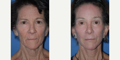 Woman treated with CO2 Laser - Woman treated with Facelift,CO2 Laser for wrinkle removal, Eyelid Surgery, as well as Brow Lift.