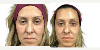 45-54 year old woman treated with Aquagold, Facial - REVIVIFY TREATMENT USING AQUAGOLD FINE TOUCH