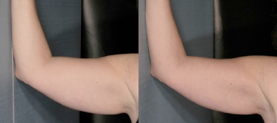 Woman treated with Velashape - Woman treated with Velashape